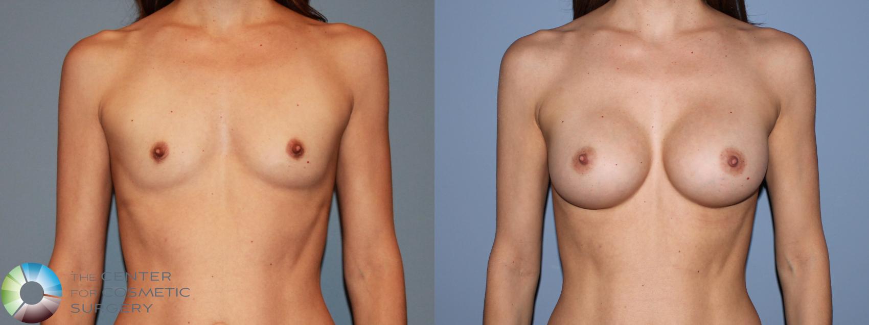 Before & After Breast Augmentation Case 481 View #1 in Denver and Colorado Springs, CO