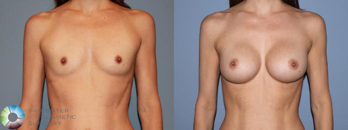Before & After Breast Augmentation Case 481 View #1 View in Golden, CO