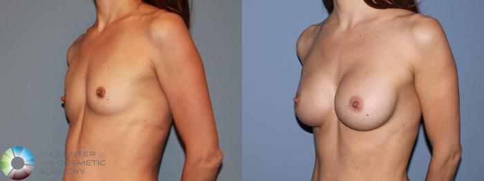 Before & After Breast Augmentation Case 481 View #2 View in Golden, CO