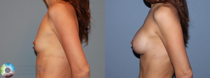 Before & After Breast Augmentation Case 481 View #3 View in Golden, CO
