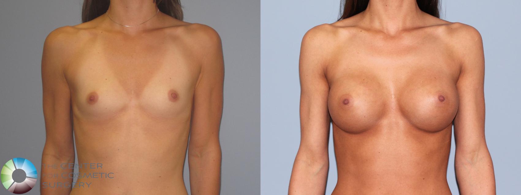 Before & After Breast Augmentation Case 485 View #1 in Denver and Colorado Springs, CO