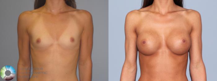 Before & After Breast Augmentation Case 485 View #1 View in Golden, CO