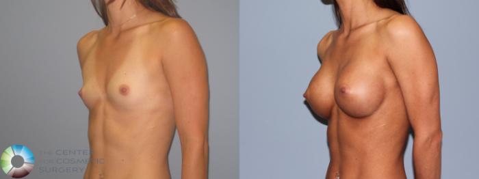 Before & After Breast Augmentation Case 485 View #2 View in Golden, CO