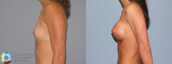Before & After Breast Augmentation Case 485 View #3 View in Golden, CO