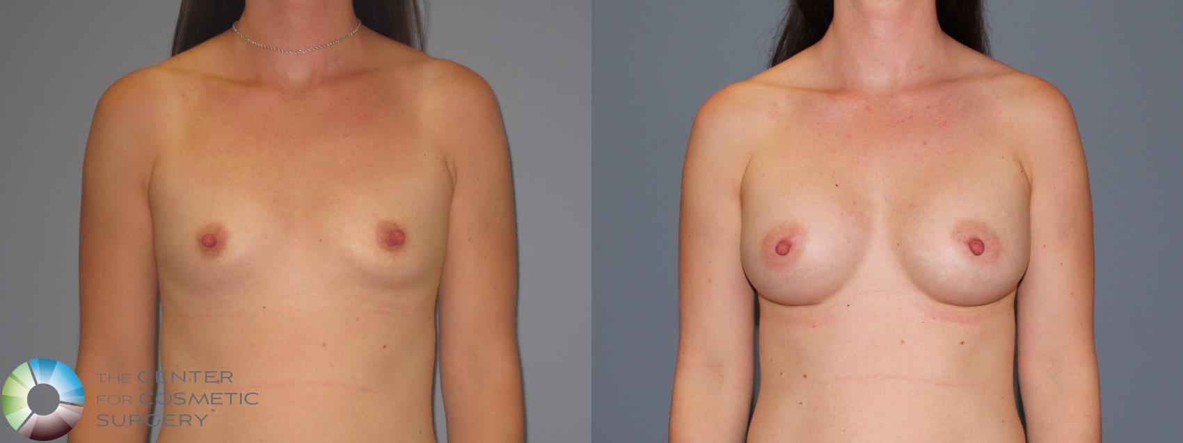 Before & After Breast Augmentation Case 486 View #1 View in Denver & Golden, CO