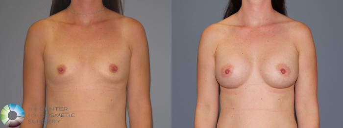 Before & After Breast Augmentation Case 486 View #1 in Denver and Colorado Springs, CO