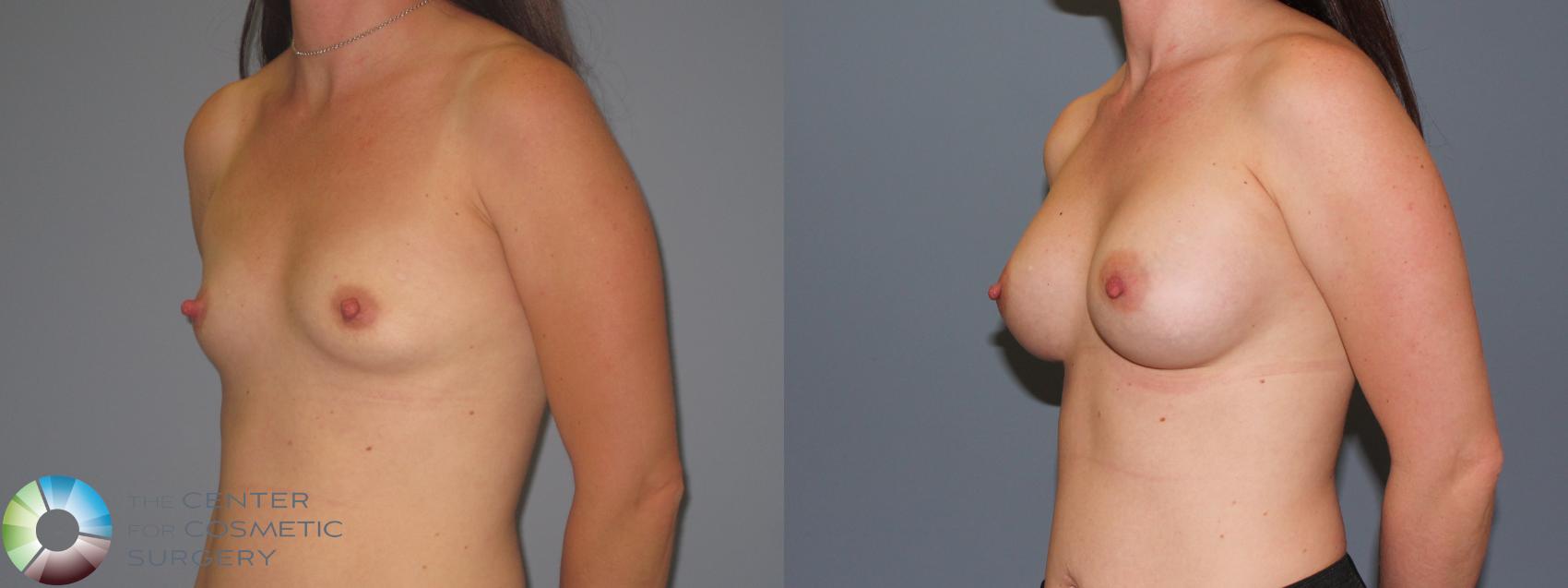 Before & After Breast Augmentation Case 486 View #2 in Denver and Colorado Springs, CO