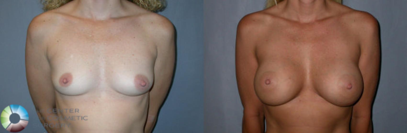Before & After Breast Augmentation Case 49 View #1 in Denver, CO