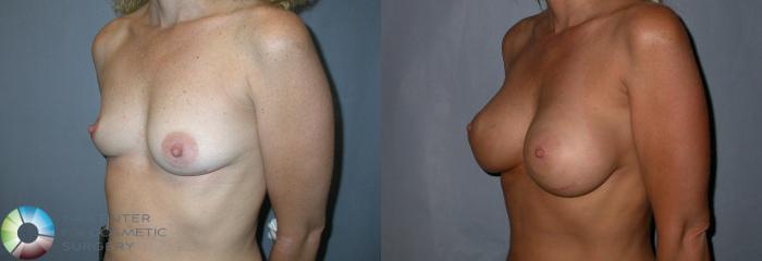 Before & After Breast Augmentation Case 49 View #2 in Denver, CO