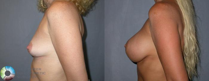 Before & After Breast Augmentation Case 49 View #3 in Denver, CO