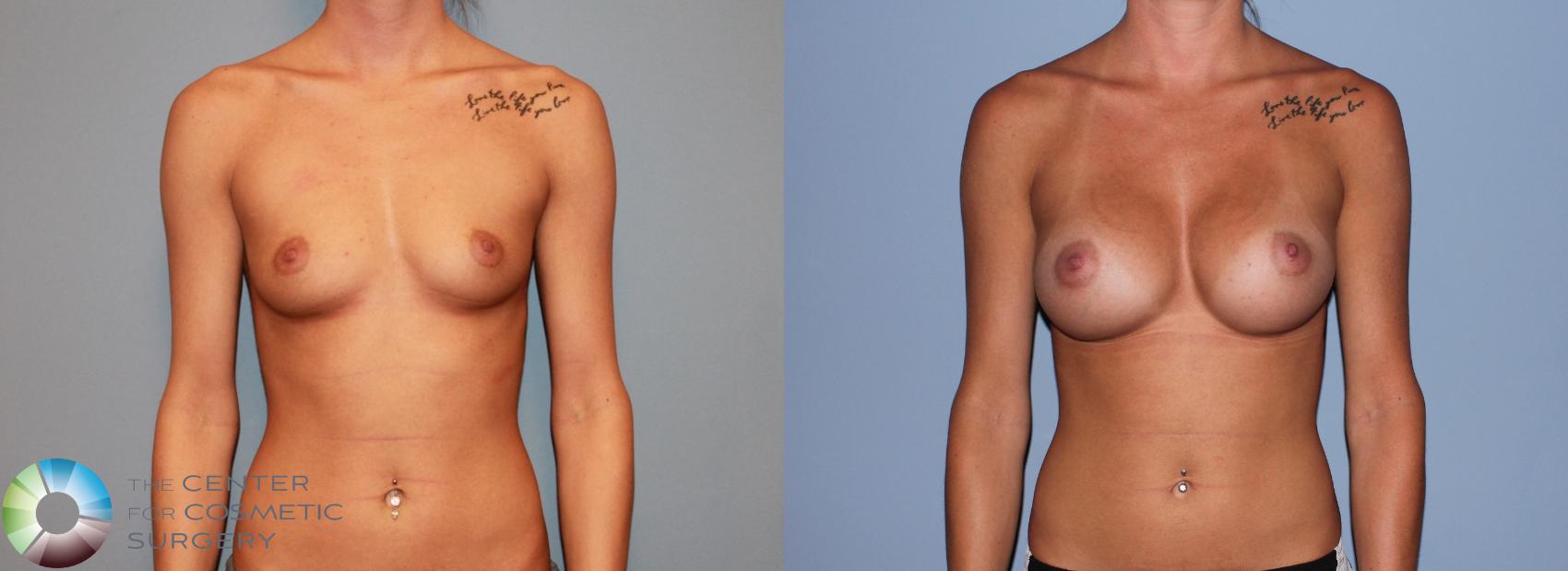 Before & After Breast Augmentation Case 492 View #1 in Denver, CO