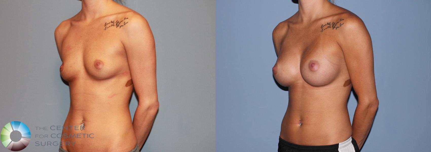 Before & After Breast Augmentation Case 492 View #2 in Denver and Colorado Springs, CO