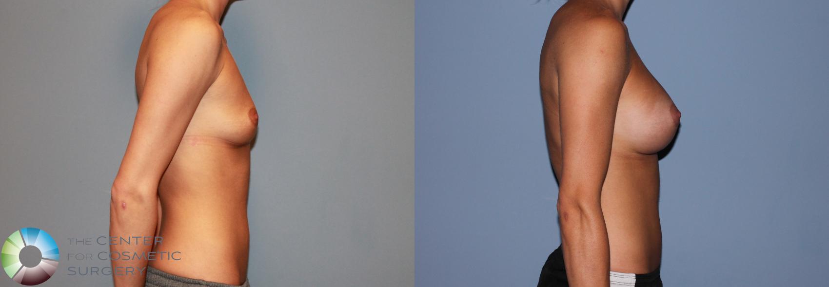 Before & After Breast Augmentation Case 492 View #3 in Denver and Colorado Springs, CO