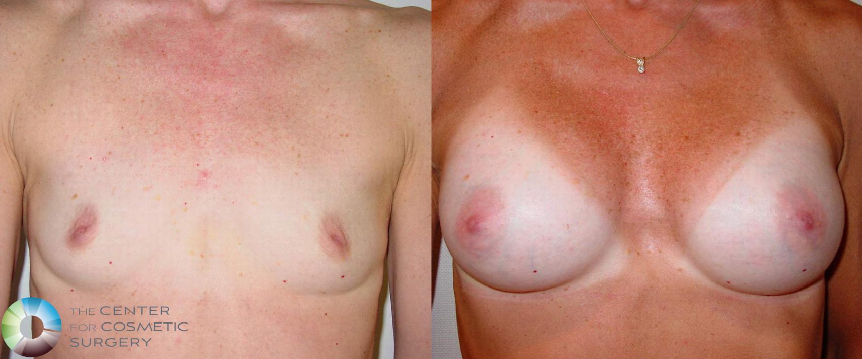 Before & After Breast Augmentation Case 496 View #1 in Denver, CO