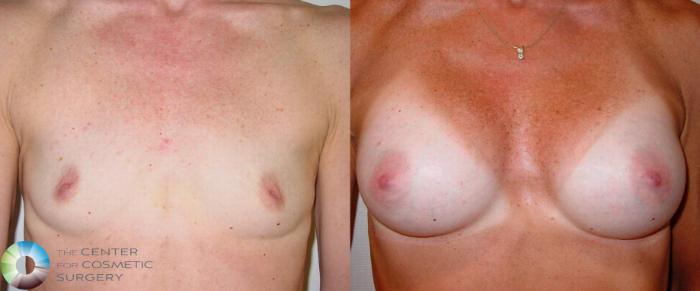 Before & After Breast Augmentation Case 496 View #1 in Denver, CO