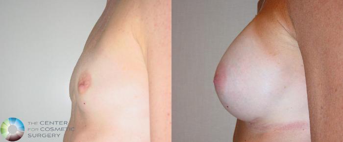 Before & After Breast Augmentation Case 496 View #2 in Denver, CO