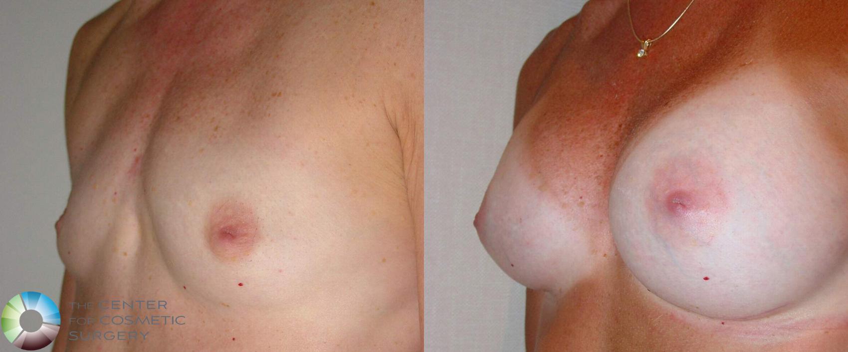 Before & After Breast Augmentation Case 496 View #3 in Denver and Colorado Springs, CO