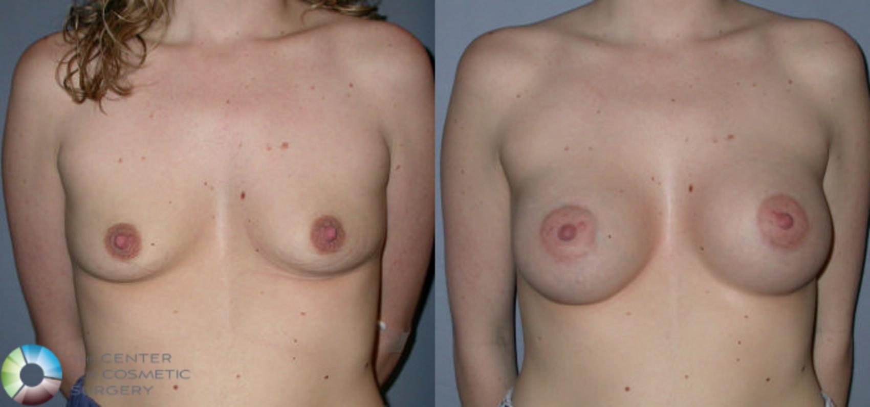Before & After Breast Augmentation Case 50 View #1 View in Golden, CO