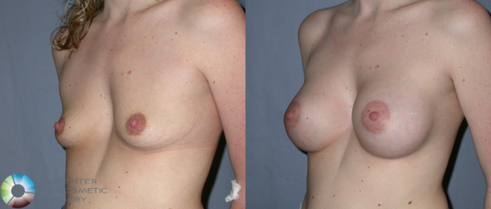 Before & After Breast Augmentation Case 50 View #2 View in Golden, CO