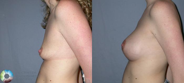 Before & After Breast Augmentation Case 50 View #3 in Denver and Colorado Springs, CO