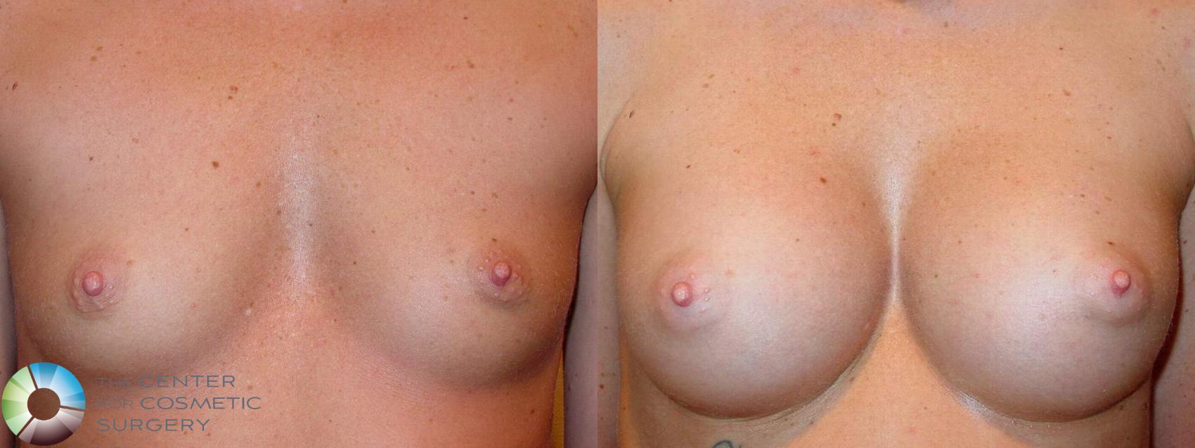 Before & After Breast Augmentation Case 512 View #1 in Denver and Colorado Springs, CO