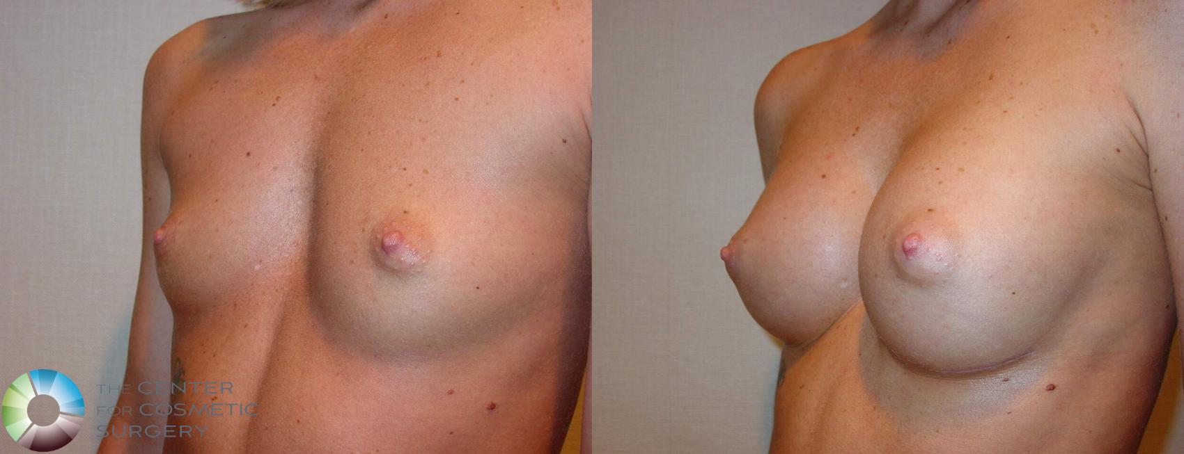 Before & After Breast Augmentation Case 512 View #2 in Denver and Colorado Springs, CO