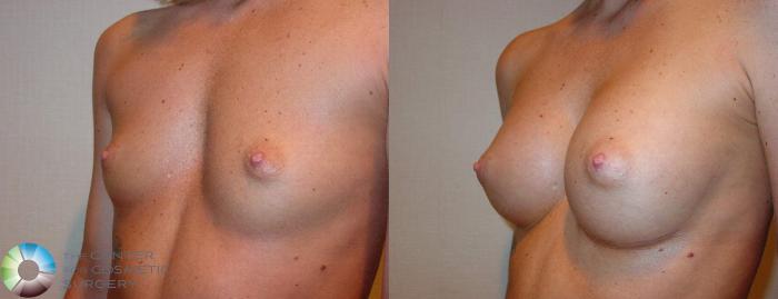 Before & After Breast Augmentation Case 512 View #2 View in Golden, CO