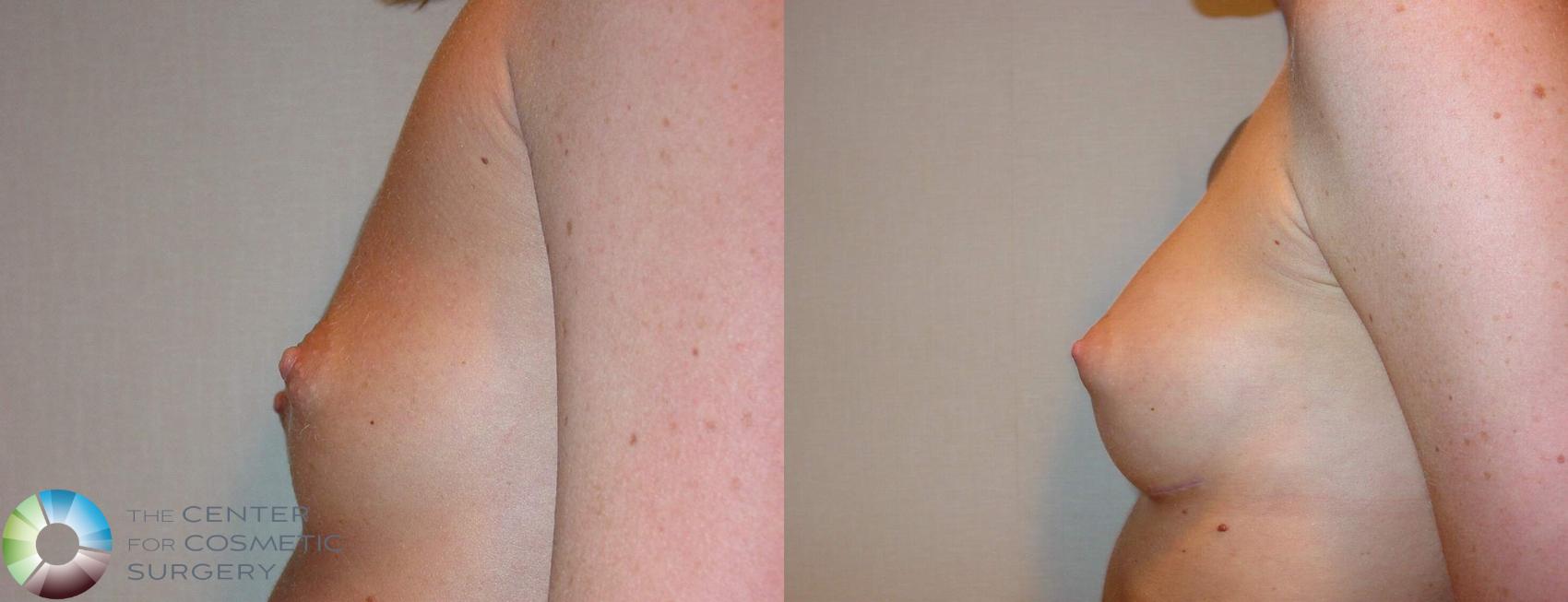 Before & After Breast Augmentation Case 512 View #3 in Denver and Colorado Springs, CO