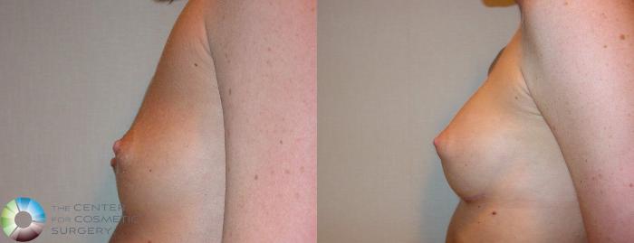Before & After Breast Augmentation Case 512 View #3 View in Golden, CO