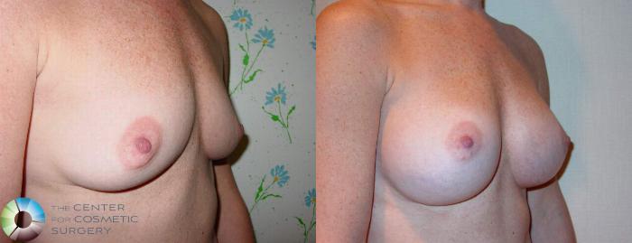 Before & After Breast Augmentation Case 513 View #1 View in Golden, CO