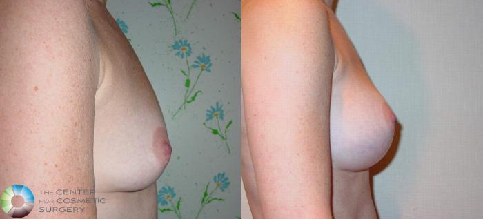 Before & After Breast Augmentation Case 513 View #2 View in Golden, CO