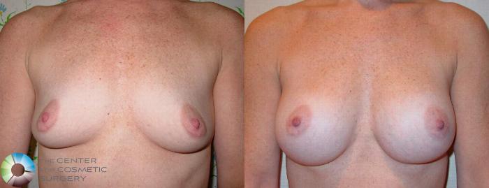 Before & After Breast Augmentation Case 513 View #3 View in Golden, CO