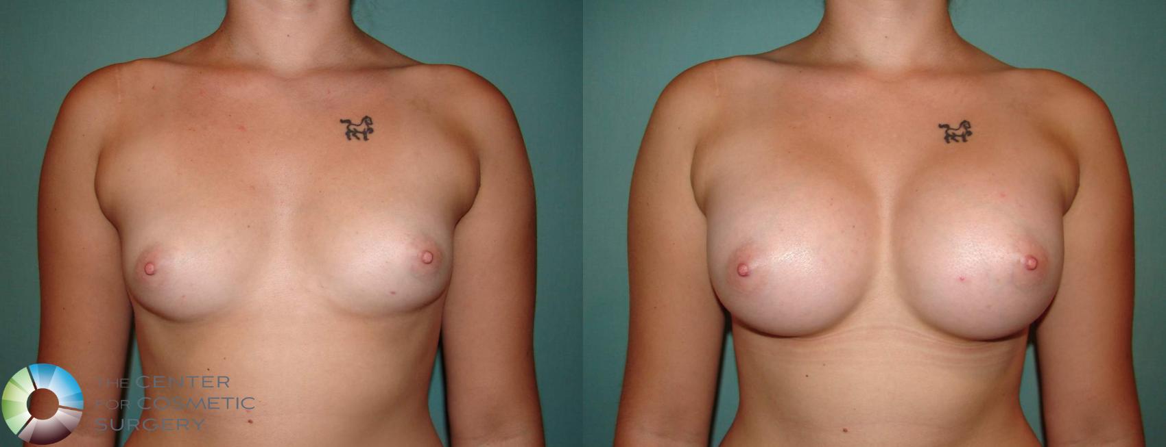 Before & After Breast Augmentation Case 514 View #1 in Denver and Colorado Springs, CO