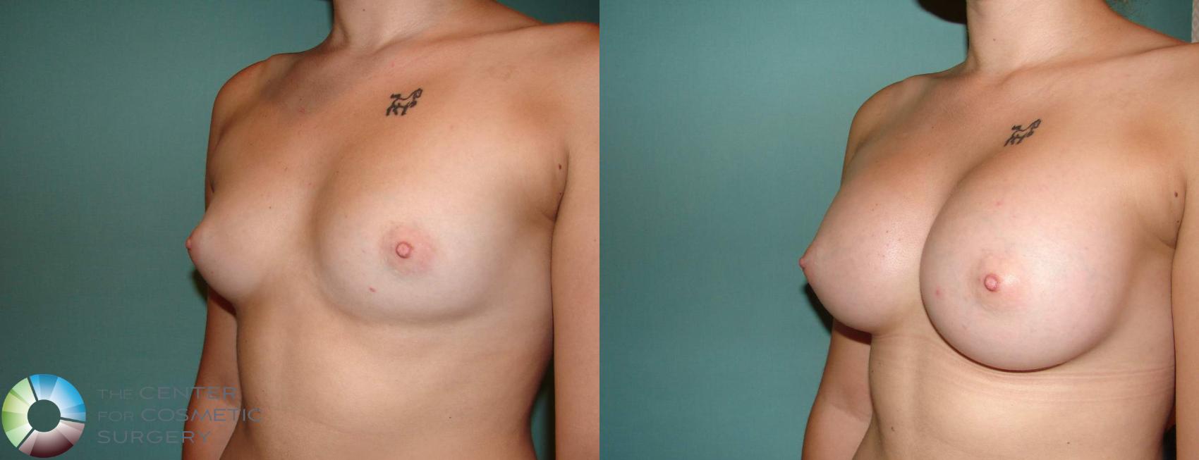 Before & After Breast Augmentation Case 514 View #2 View in Golden, CO