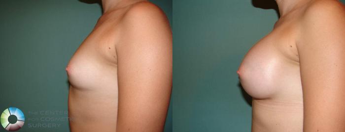 Before & After Breast Augmentation Case 514 View #3 View in Golden, CO