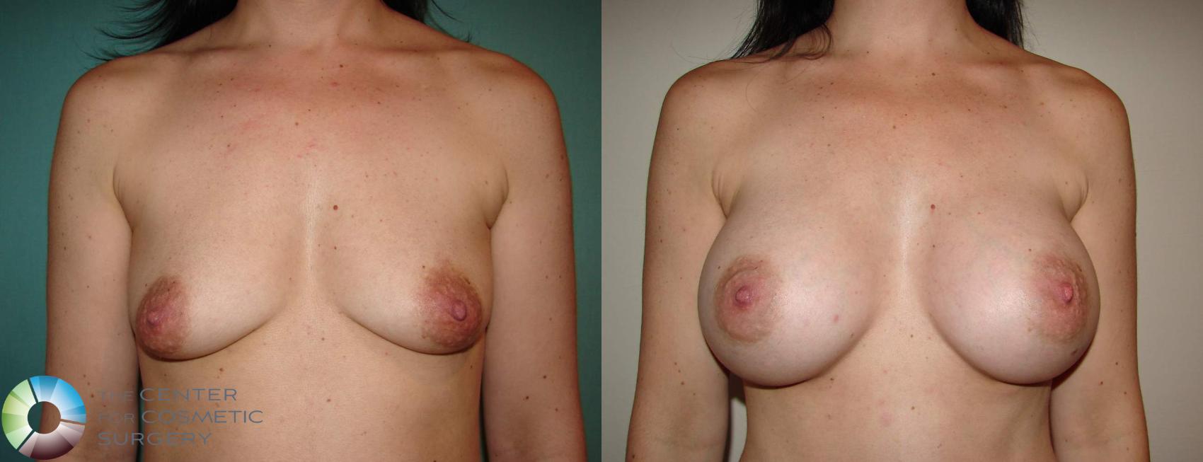 Before & After Breast Augmentation Case 515 View #1 in Denver and Colorado Springs, CO