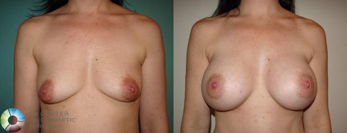 Before & After Breast Augmentation Case 515 View #1 View in Golden, CO