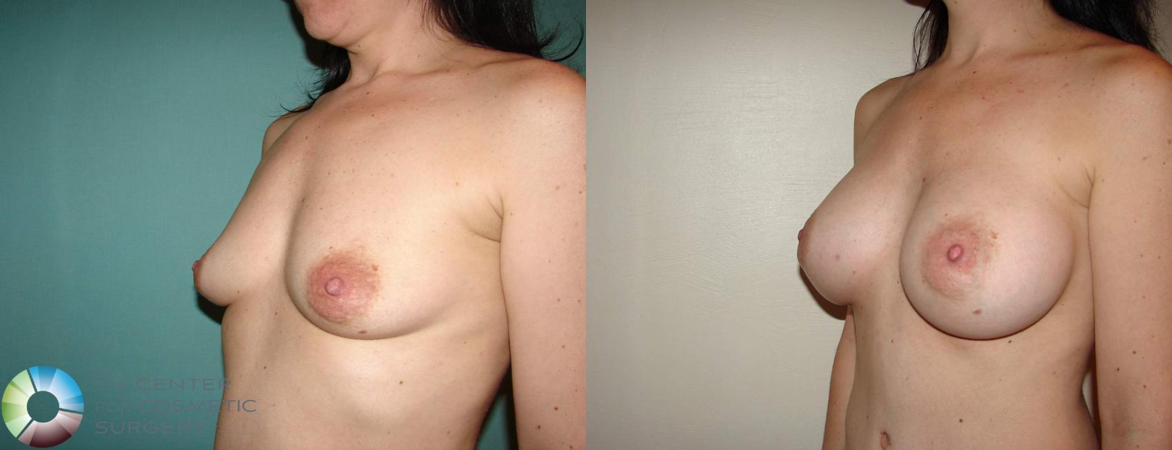 Before & After Breast Augmentation Case 515 View #2 in Denver and Colorado Springs, CO