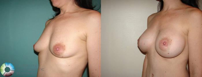 Before & After Breast Augmentation Case 515 View #2 View in Golden, CO