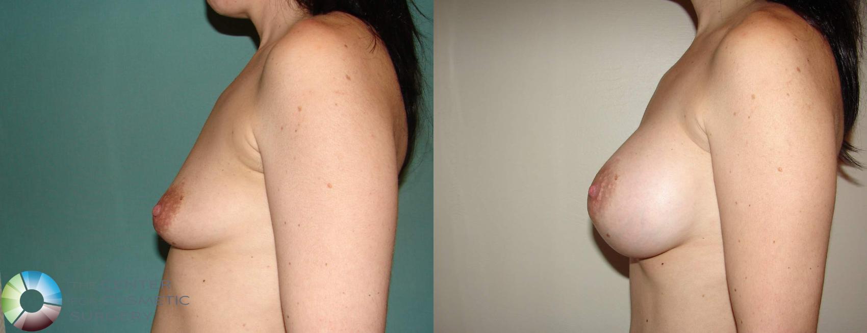 Before & After Breast Augmentation Case 515 View #3 in Denver and Colorado Springs, CO