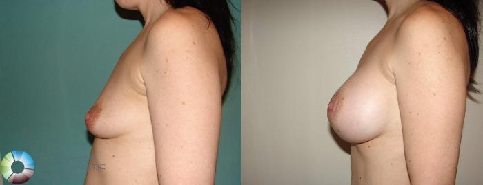 Before & After Breast Augmentation Case 515 View #3 View in Golden, CO