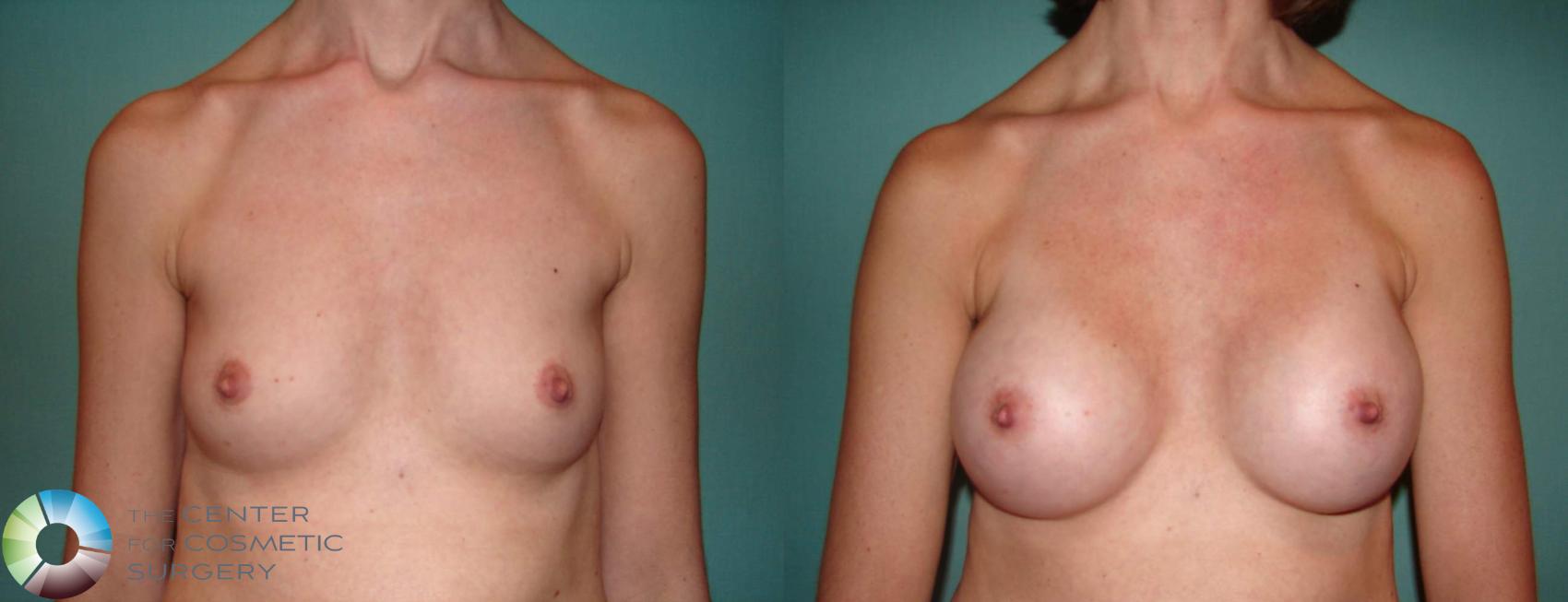 Before & After Breast Augmentation Case 516 View #1 in Denver and Colorado Springs, CO