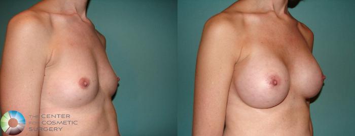 Before & After Breast Augmentation Case 516 View #2 View in Golden, CO