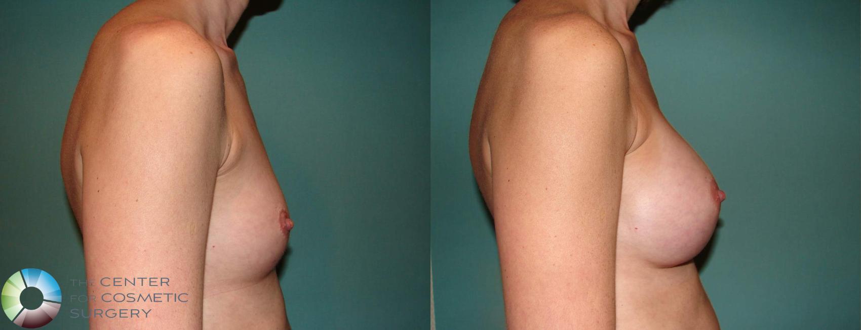 Before & After Breast Augmentation Case 516 View #3 View in Golden, CO