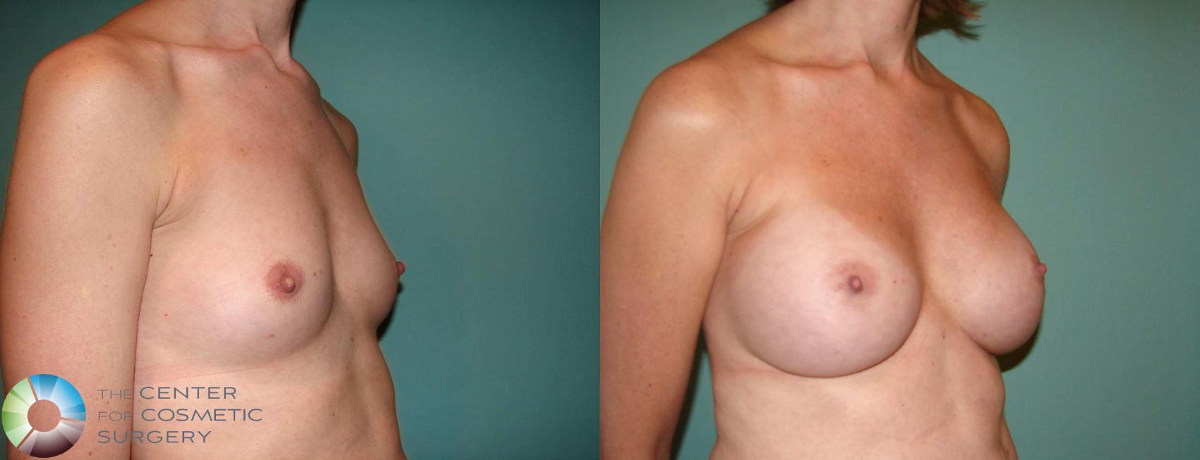 Before & After Breast Augmentation Case 516 View #4 View in Golden, CO