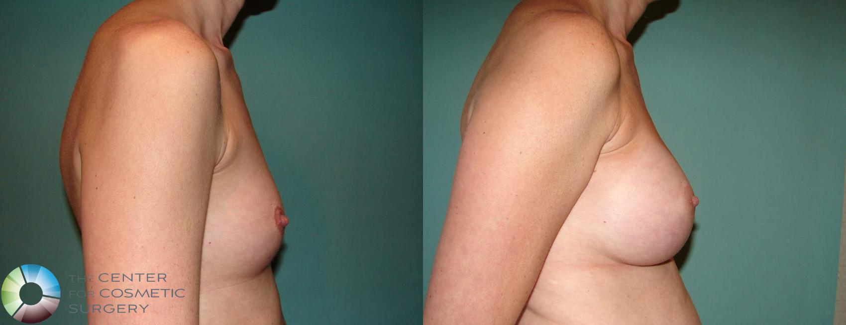 Before & After Breast Augmentation Case 516 View #5 View in Golden, CO
