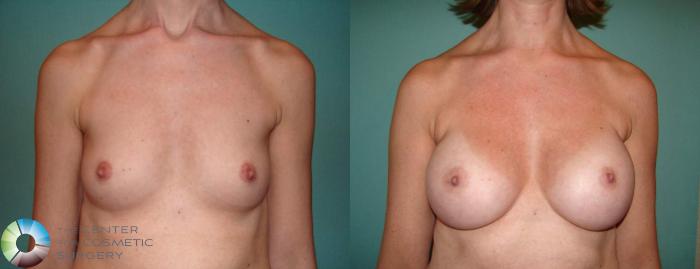 Before & After Breast Augmentation Case 516 View #6 View in Golden, CO
