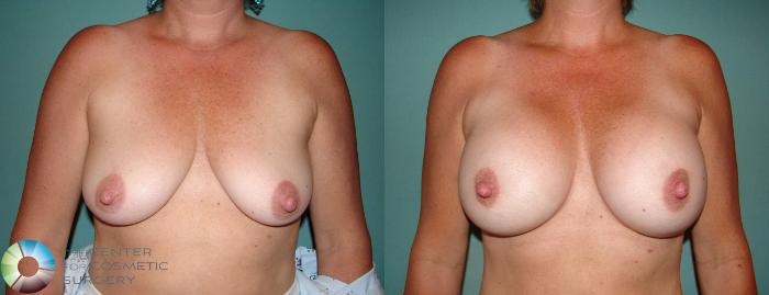 Before & After Breast Augmentation Case 527 View #1 in Denver and Colorado Springs, CO