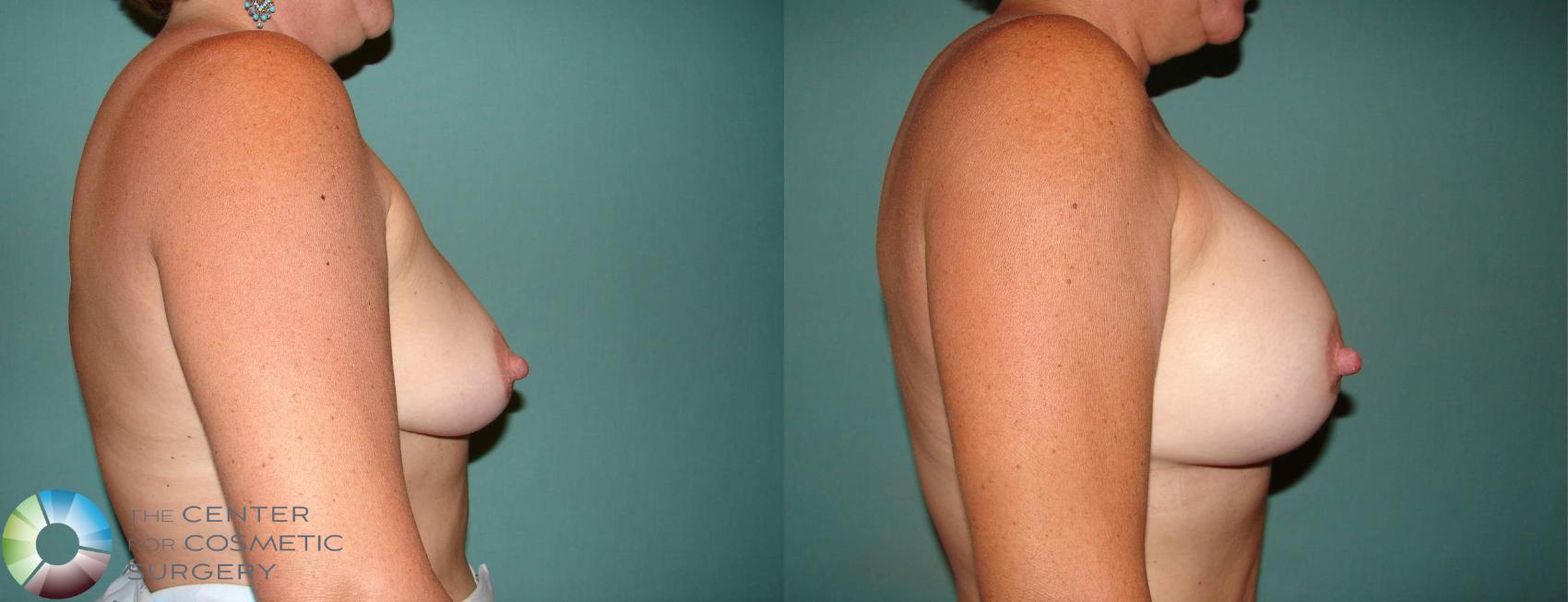Before & After Breast Augmentation Case 527 View #2 View in Golden, CO