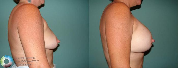 Before & After Breast Augmentation Case 527 View #2 in Denver and Colorado Springs, CO